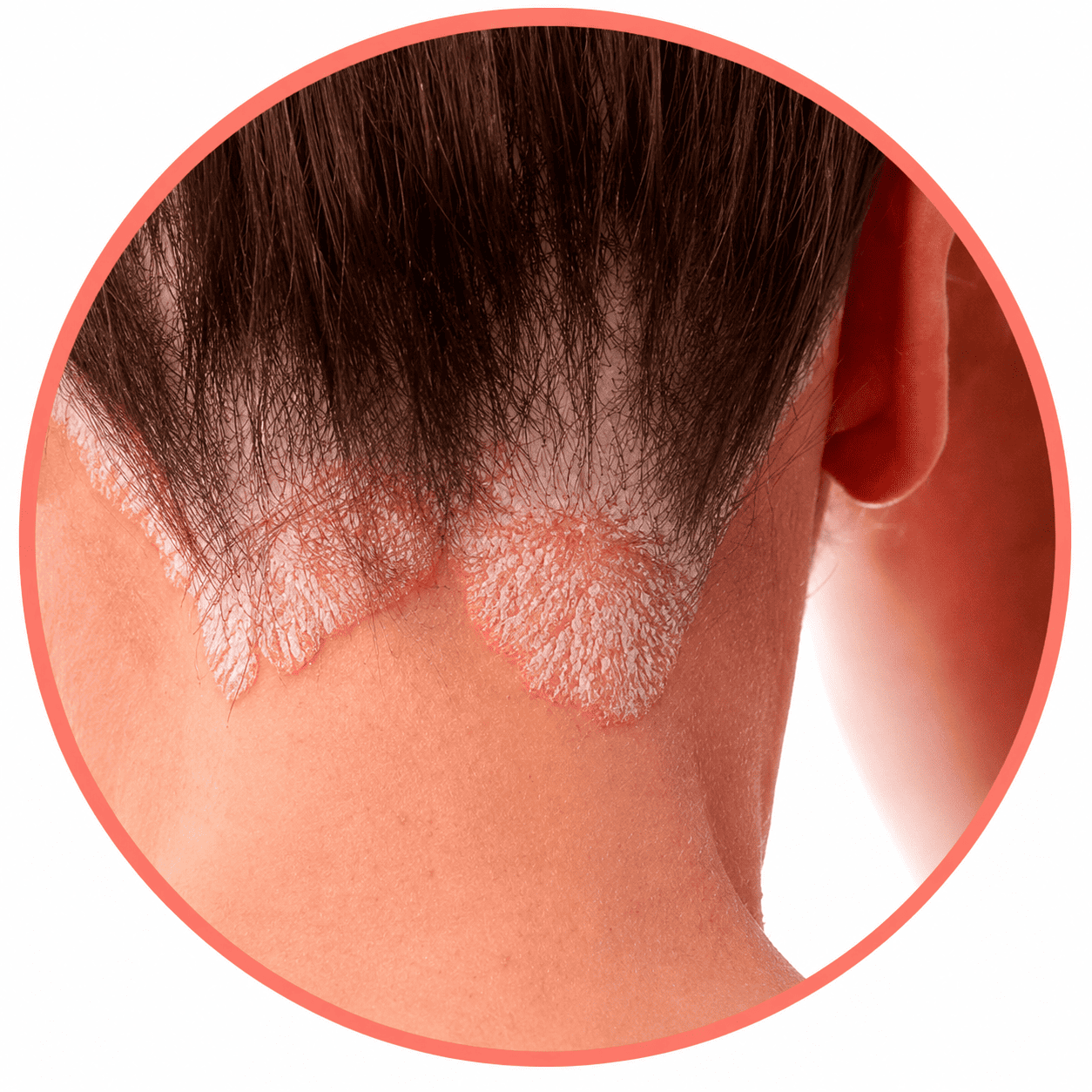 Psoriasis