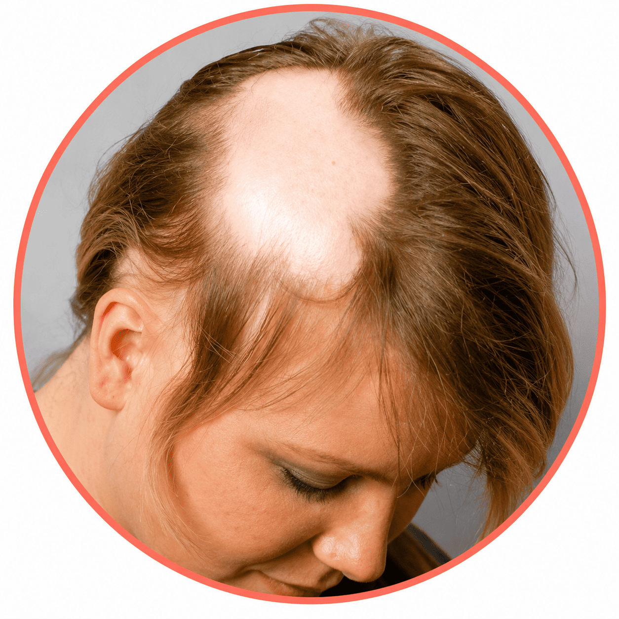 alopecia areata