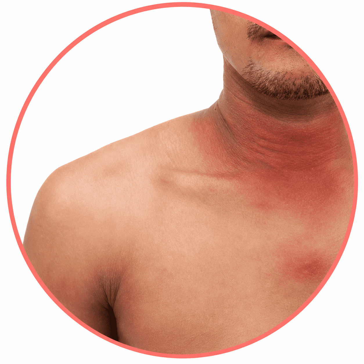 dermatritis