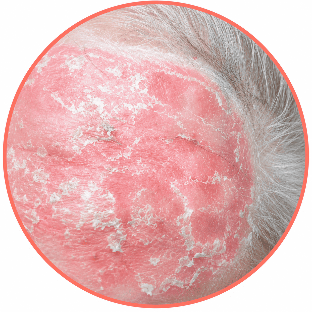 microsis fungoide