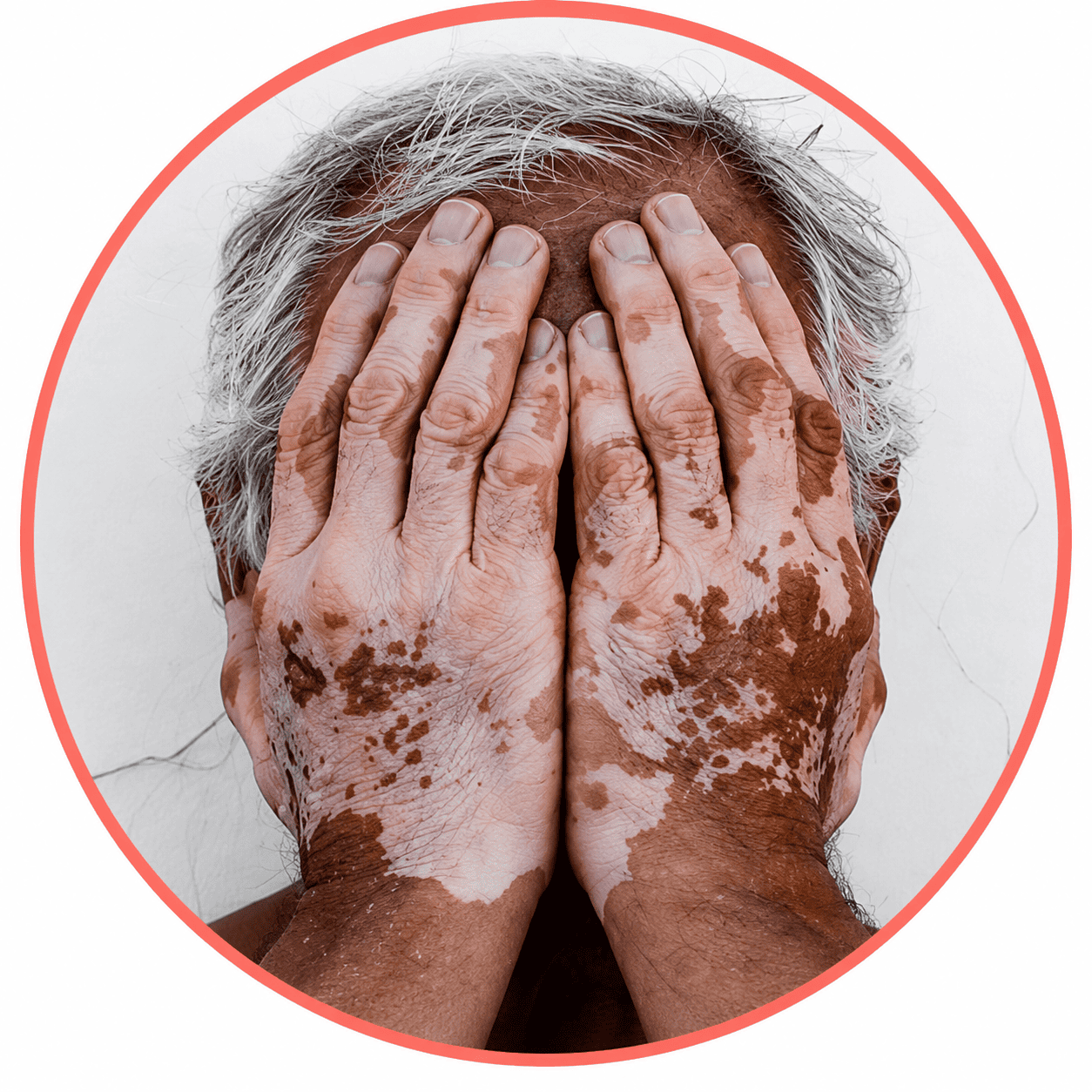 vitiligo